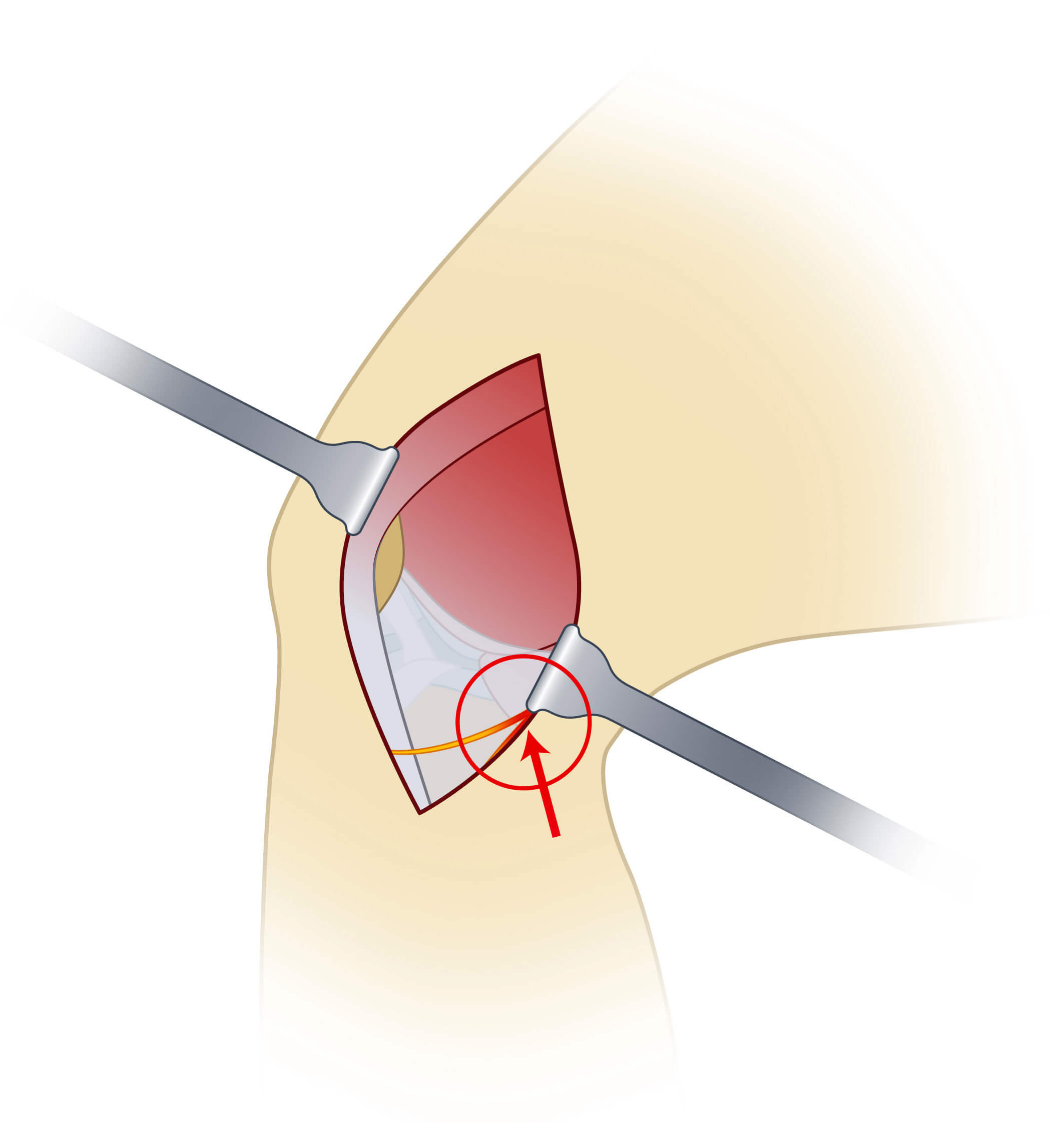 Infrapatellaris Verletzung Knie OP, Nervenverletzung nach Knie OP, Ramus infrapatellaris Syndrom
