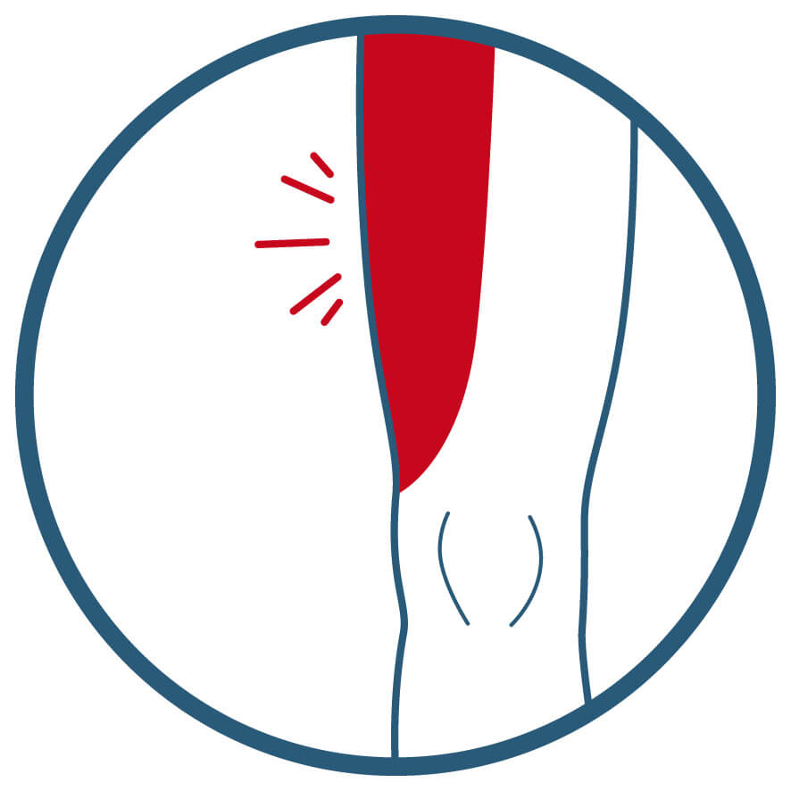 PUC Meralgia paraesthetica Diagnose und Therapie mittels HDUltraschall