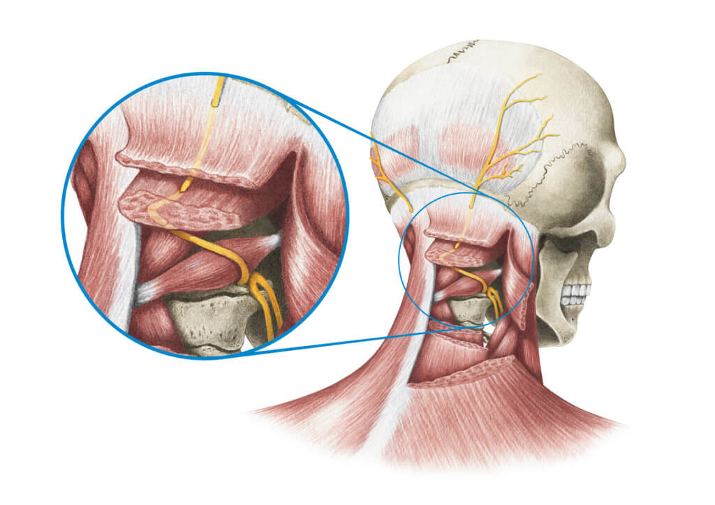 Nervus Occipitalis Major Eingeklemmt Symptome